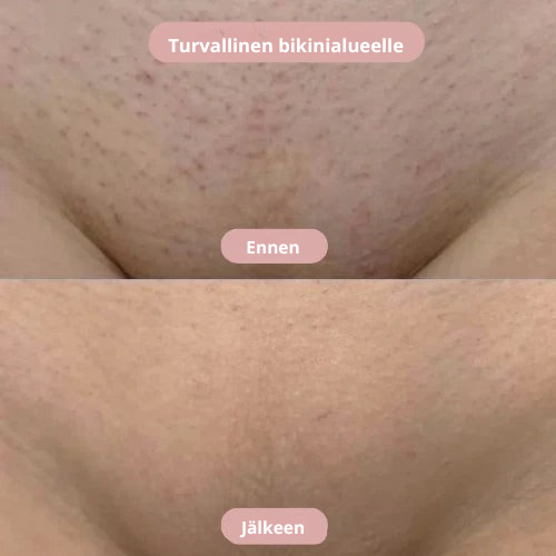 Silkskin- Intiimialueen ajo ilman ärsytystä